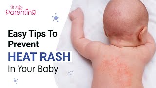 How to Treat and Prevent Heat Rash in Babies [upl. by Fowle]