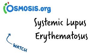 Systemic Lupus Erythematosus  Clinical Presentation [upl. by Evelunn]