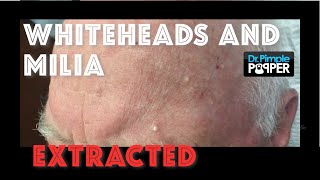 Whiteheads and milia extracted after Mohs surgery [upl. by Eardna925]