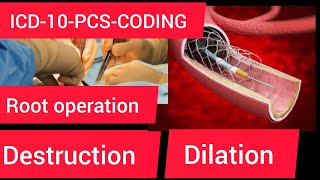 ICD10PCS codingRoot operation destruction amp dilation [upl. by Oknuj]