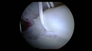 Hip Arthroscopy Labral Repair Surgery  Repair Torn Hip Labrum  Dr David J King [upl. by Filmore418]