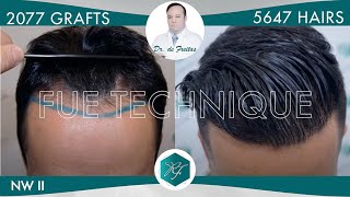 Injerto Capilar Técnica FUE – 2077 Grafts 5647 Pelos – Dr Rafael de Freitas [upl. by Therese677]