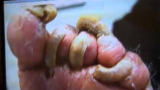 What is a fungal nail infectionMinnesota Podiatrist Explains wwwinnovativefootcarecom [upl. by Toolis]