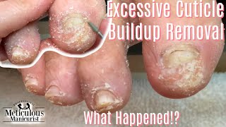 How To Pedicure a Diabetic Foot Tutorial and Tips Follow Up Part 1 [upl. by Mulcahy]