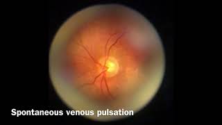 Spontaneous venous pulsation [upl. by Melvena]