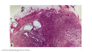 BREASTPATH 20240719 Breast fibroepithelial lesions fibroadenoma phyllodes tumor hamartoma [upl. by Switzer]