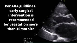 Cardiac vegetations in focus [upl. by Fredella]