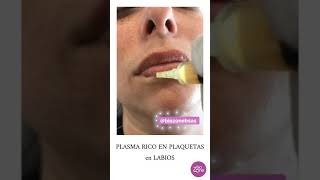 Plasma Rico en Plaquetas en Labios ¿Querés Ver Cómo es Bienvenidos a Biozone Medicina Estética [upl. by Unam517]