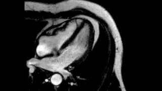 Constrictive pericarditis fourchamber ECGgated cine SSFP MR [upl. by Ecirehs646]