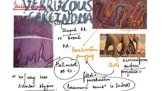 Verrucous carcinoma [upl. by Iiette177]