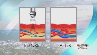 Acoustic wave therapy treating core issue of mens ED [upl. by Milstone]