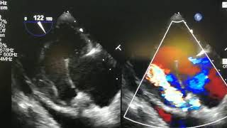 Severe AR due to Paravalvular leak after AVR [upl. by Kcirdaed]