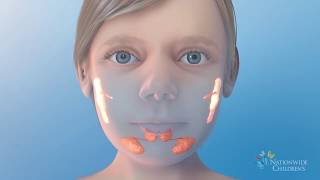 Salivary Gland Ablation  Treatment for Ranulas or Sialorrhea excessive drooling [upl. by Meehsar]