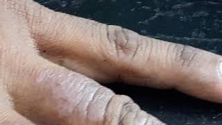 Cement dichromate Irritant contact dermatitis [upl. by Janette]