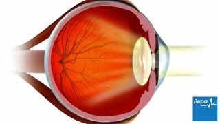 How LASIK eye surgery is carried out [upl. by Didi483]