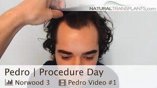 Defeating a Receding Hairline Hair Transplant at 23 for Norwood 3 Hair Loss  Dr Huebner Pedro [upl. by Ocirderf603]