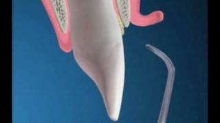 Periodontal Flap Surgery [upl. by Yllas]