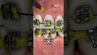 ¡🔥FORMAS Y ESTILOS de instalar las ligas de color en los brackets 😬🔥 [upl. by Chastain226]