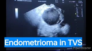 endometrioma sonography ovariancyst hydrosalpinxultrasound of ovary endometrioma endometriosis [upl. by Vickey]