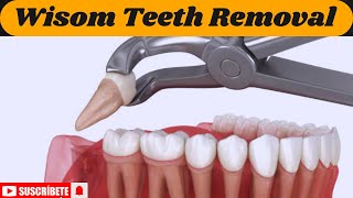 Wisdom Teeth Removal Do You Really Need It StepbyStep Procedure Explained 3D animation  MHCP [upl. by Assylla]