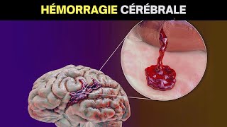 Que se passetil en cas dhémorragie cérébrale  Symptômes causes et traitement [upl. by Euqinmod544]