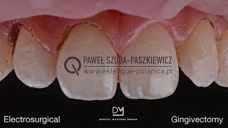 Electrosurgical Gingivectomy  Crown Lengthening [upl. by Everara]