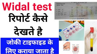 Widal test रिपोर्ट कैसे देखते है  Typhoid Test कैसे किया जाता है [upl. by Aicargatla421]