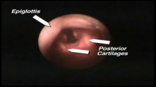 Clarus Levitan FPS Viewing Stylet Scope  4 Endotracheal Intubation Case Examples [upl. by Klarrisa7]