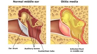 Otitis Media [upl. by Eyma52]