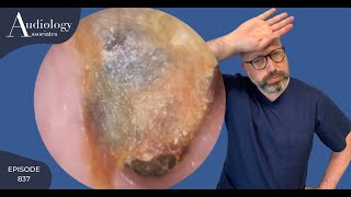 DEEP DRY amp DIFFICULT EAR WAX REMOVAL EP837 [upl. by Rebmit]