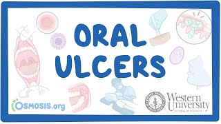 Western University  Oral Ulcers [upl. by Ferdinand]