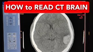 How to Read a CT Scan BRAIN [upl. by Nnayllek922]