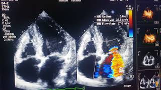 acute coronary syndromeNSTEMI [upl. by Parish]