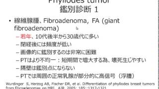 Phyllodes tumor answer 20140707 WMV [upl. by Asil]