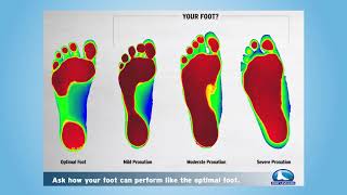 Breaking down the biomechanics of custom orthotics [upl. by Eugirne]