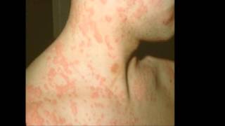 Natural Urticaria Relief  Get Rid of Hives [upl. by Nywg13]