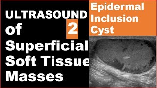 Epidermoid inclusion cyst on Ultrasound [upl. by Dnyletak539]