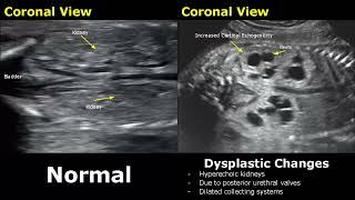 Fetal Kidneys Ultrasound Normal VS Abnormal Image Appearances  Kidney Abnormalities USG  ObGynae [upl. by Scherle35]