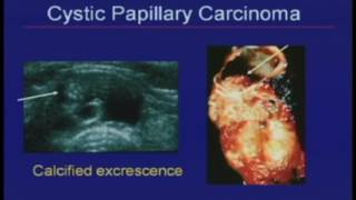 Thyroid Nodules Sonographic Evaluation and Biopsy Recommendations [upl. by Letsou889]