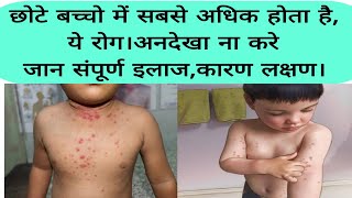 molluscum contagiosum disease causessymptoms and full treatmentछोटे बच्चो में अधिक होने बाला रोग। [upl. by Jaela]