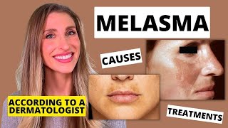 Best Melasma Treatment Dermatologist Explains Melasma Causes At Home Treatments amp More [upl. by Suilenrac431]