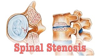 Spinal Stenosis  Surgery vs Chiropractic Care [upl. by Mclaughlin754]