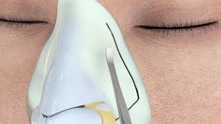 Ultrasonic Rhinoplasty [upl. by Alliehs]