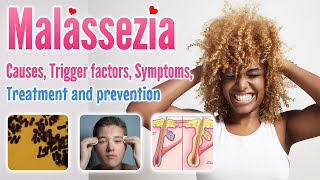 Malassezia causes conditions symptoms trigger factor treatment and prevention [upl. by Rubie]