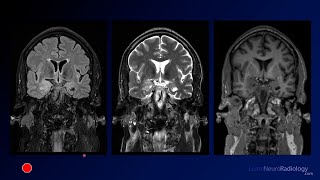 Neuroradiology Board Review  Brain Tumors  Case 13 [upl. by Service]