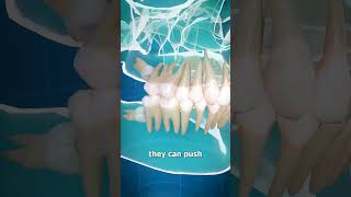 Wisdom Teeth Removal at Partha Dental Expert Care for Lasting Relief [upl. by Dorine920]