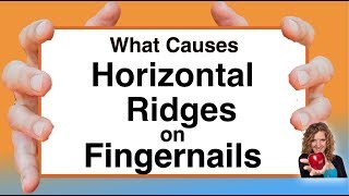 What Causes Horizontal Ridges on Nails With Karen Langston [upl. by Kathryn]