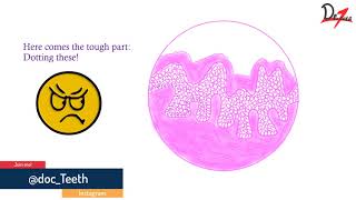 Verrucous carcinoma Histopathological features lets draw [upl. by Harte]