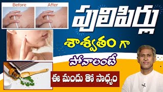 Home Remedy for Warts  Health Tips in Telugu  DrManthenaOfficial [upl. by Snodgrass]