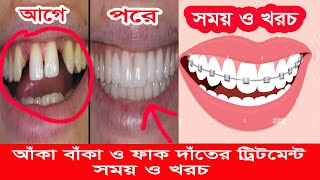 আঁকা বাঁকা দাঁত সোজা করা  aka baka dat soja korar upay ।।orthodontic treatment ।। uchu dat nichu [upl. by Lattie]